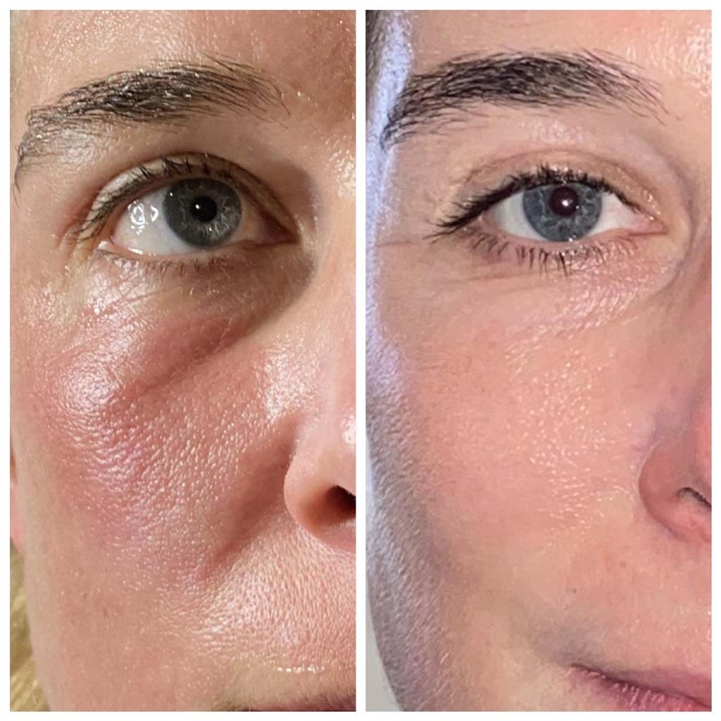 Fraxel Laser Before and After Image