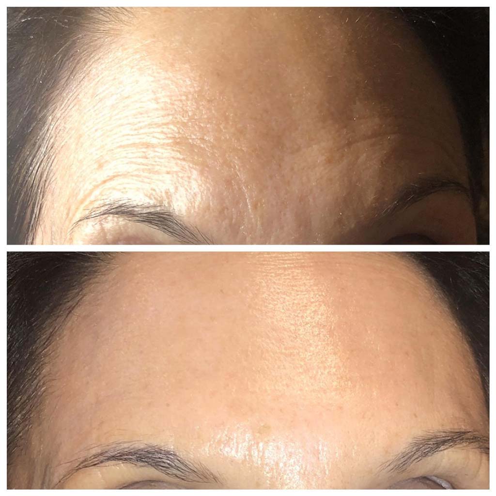Fraxel Laser Before and After Image