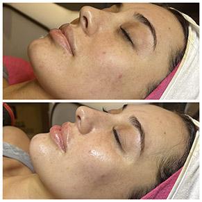 JetPeel Pro Facial Before and After Image