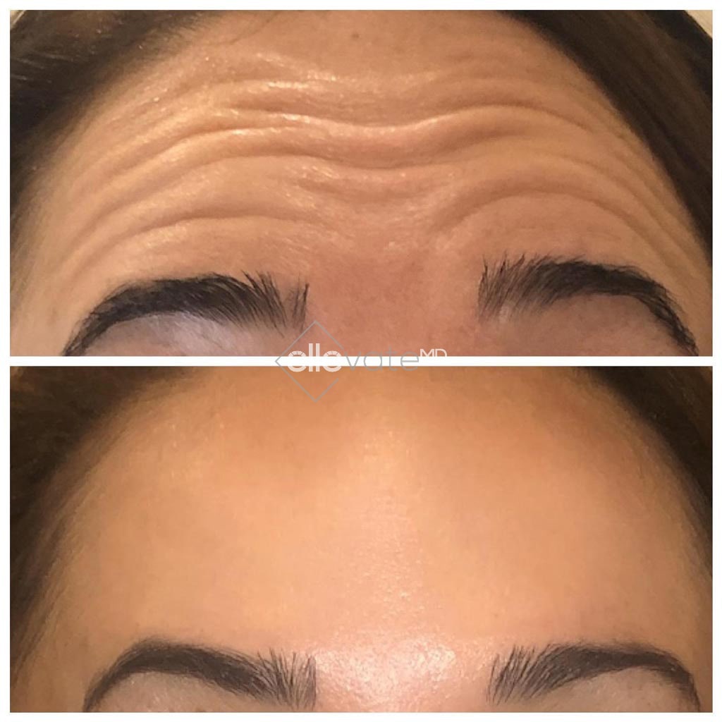 Botox Before and After Image