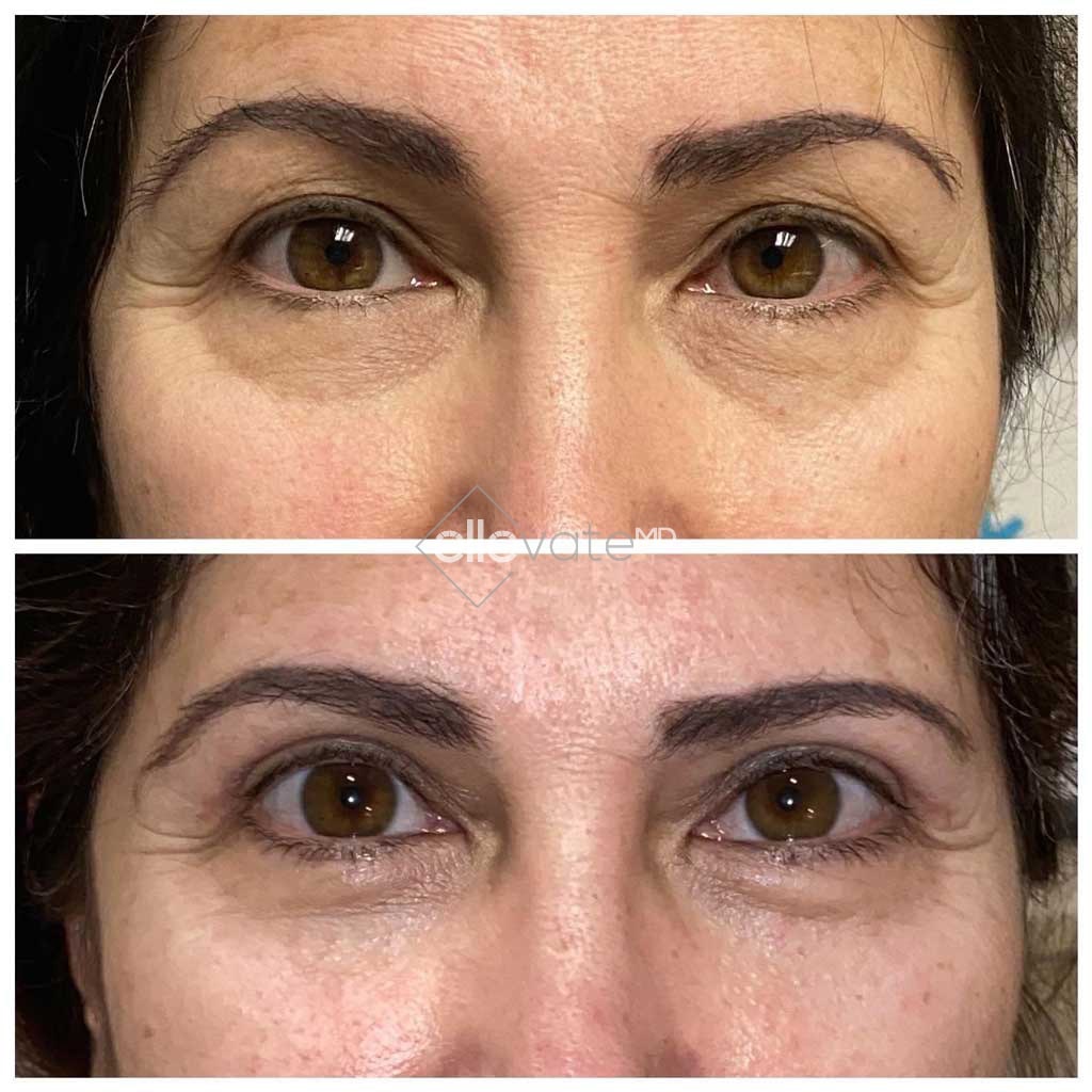 Ellevate Bag Treatment Before and After Image