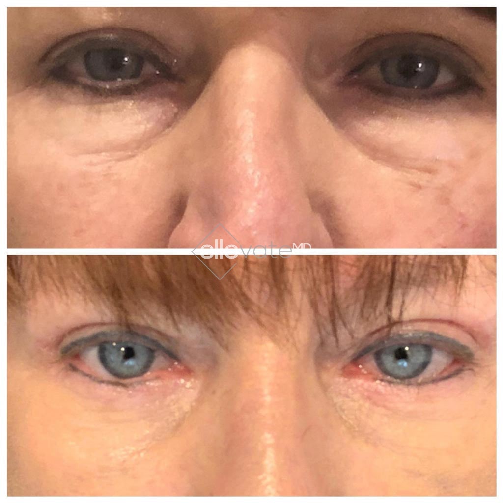 Ellevate-Bag-Treatment-Before-and-After