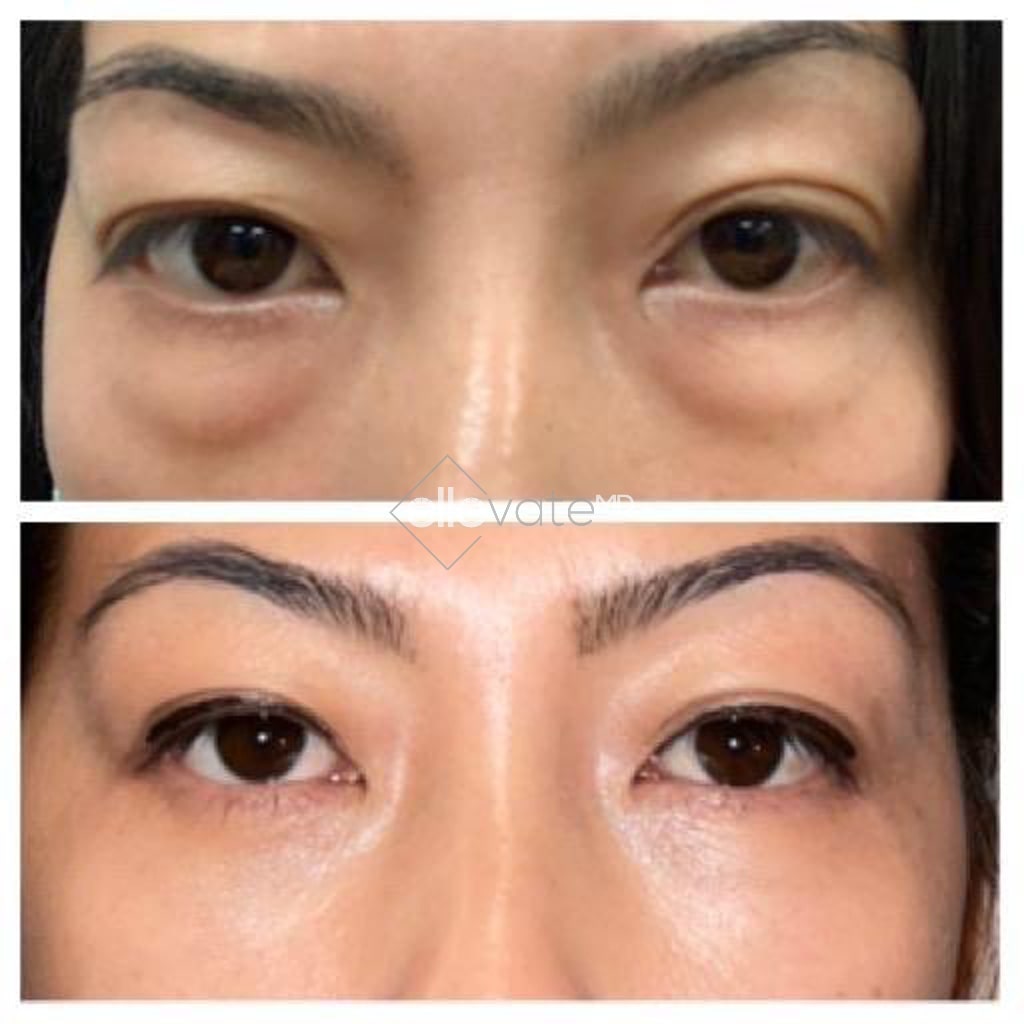 Ellevate Bag Treatment Before and After Image