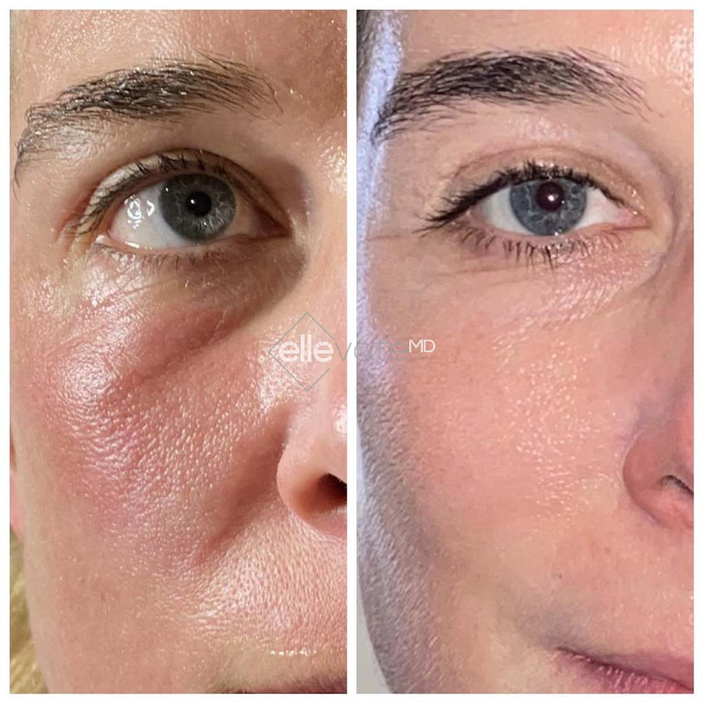 Fraxel-Laser-Before-and-After-Image