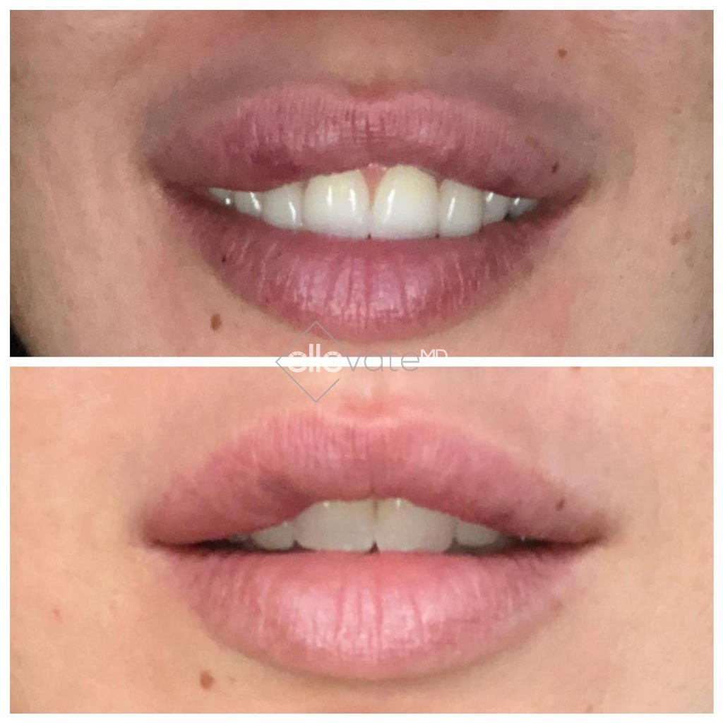 Lip Before and After Image