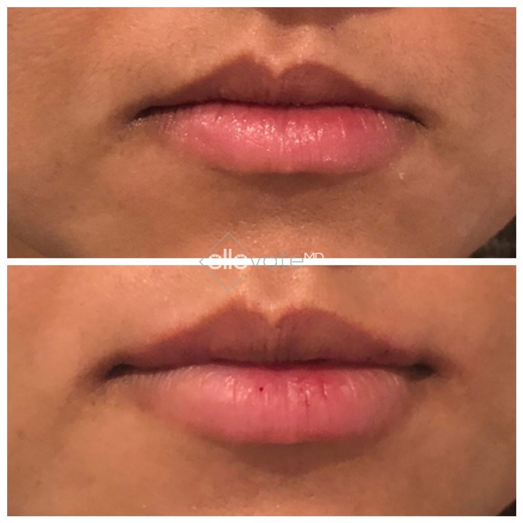 Lip Before and After Image