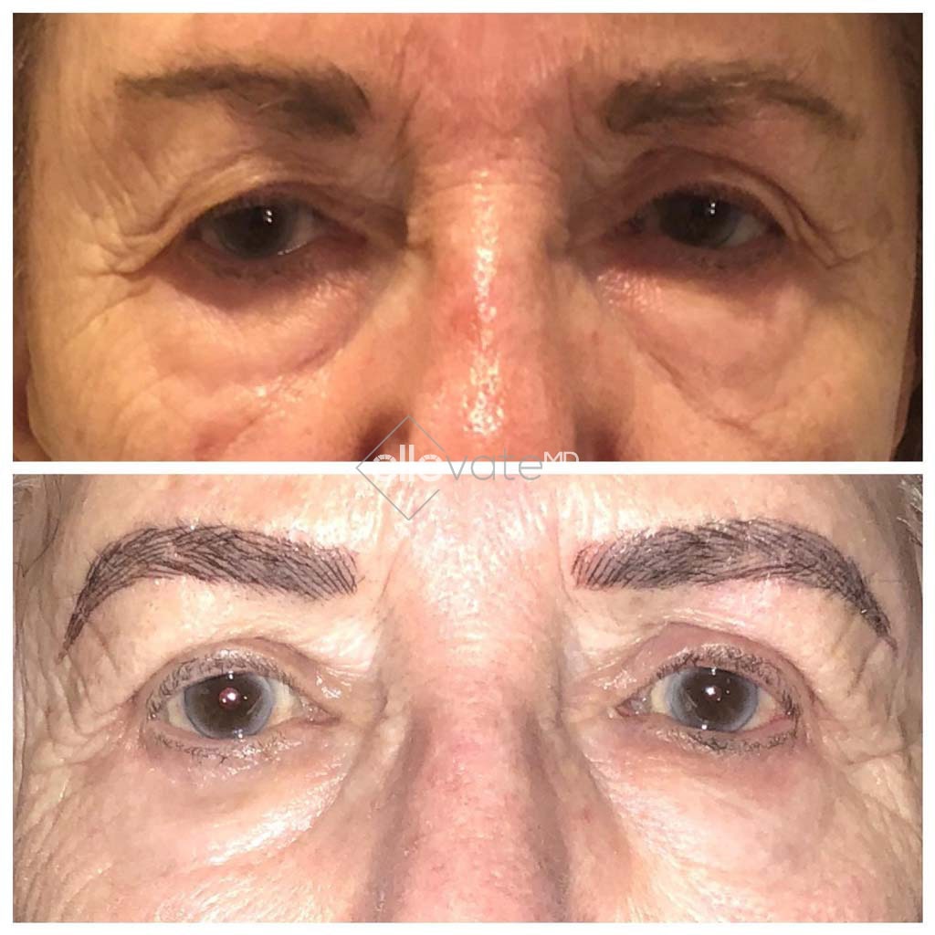 Ptosis Repair Before and After Image