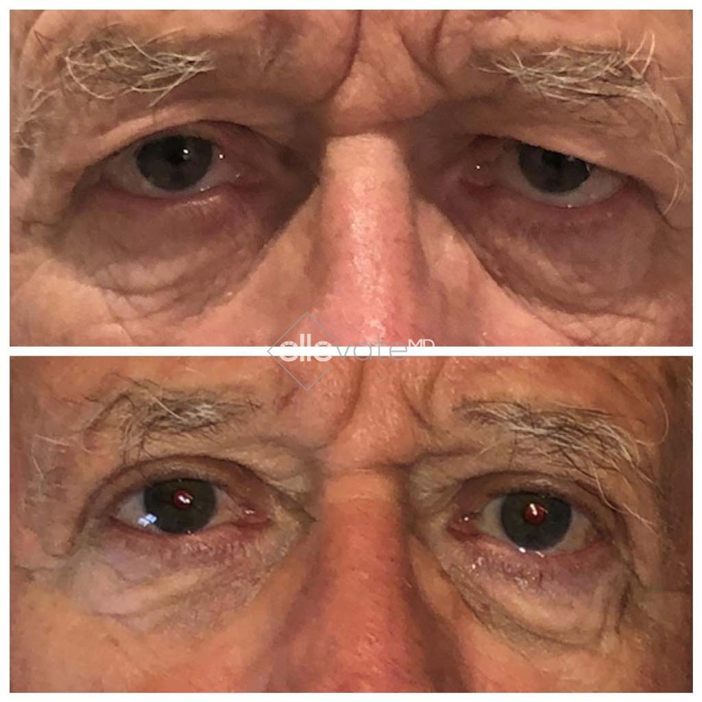 Ptosis Repair Before and After Image