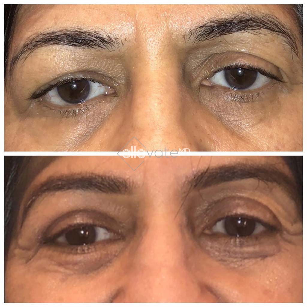 Upper Lid Lift for Asymmetry Before and After Image
