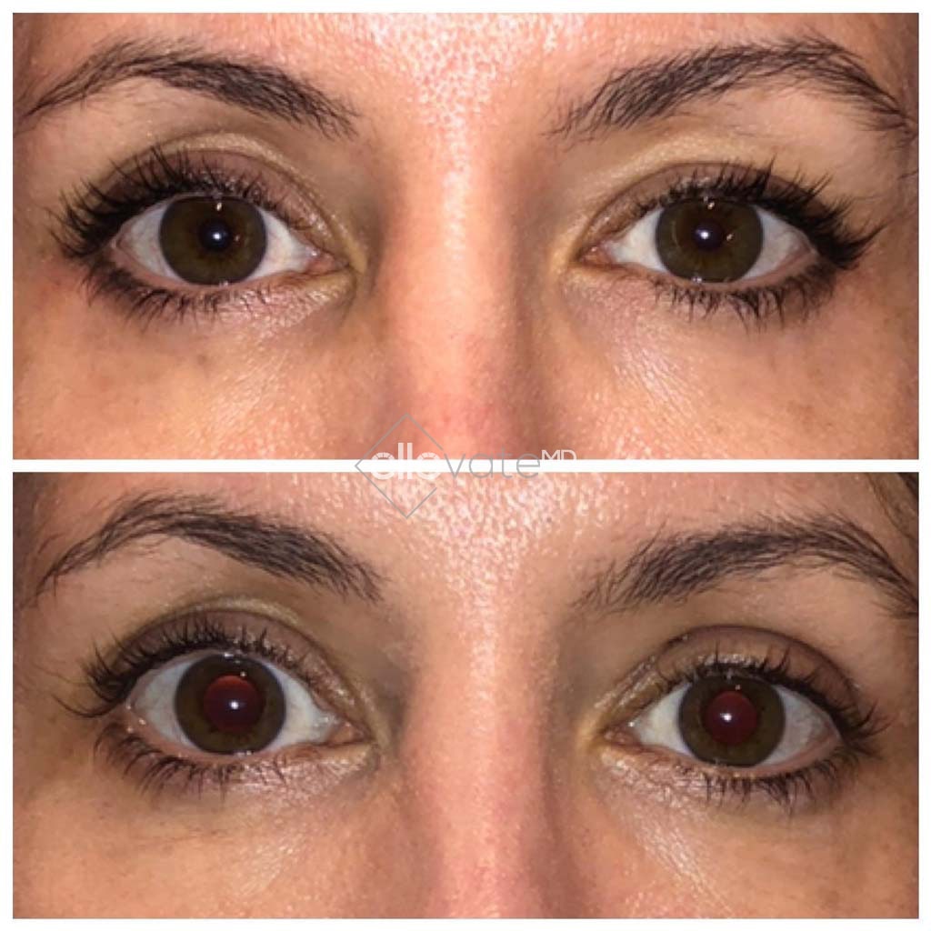 Upper Lid Lift for Asymmetry Before and After Image