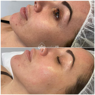 ellevate-JetPeel-Pro-before-and-after